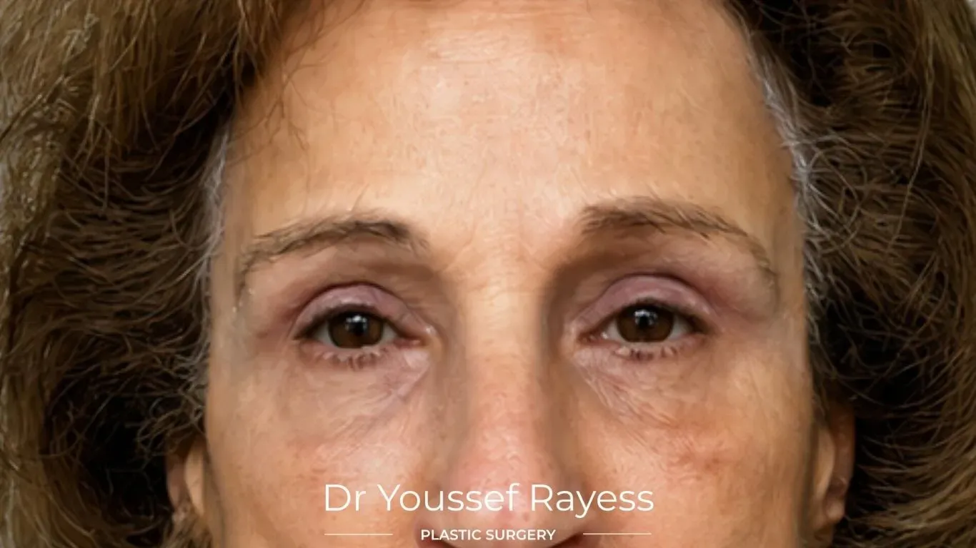 Close-up front view after brow lift result by Dr Youssef Rayess in Beirut and Dubai showing natural brow refinement and facial harmony
